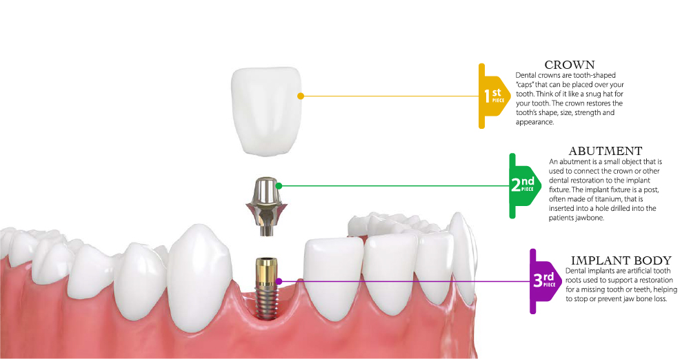 dentist_implantcalisma_yuzeyi_2-100_1